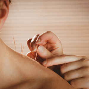 kann-akupunktur-immunsystem-staerken