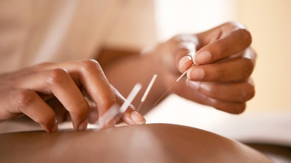acupuncture
